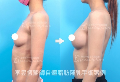 自體脂肪隆乳-26