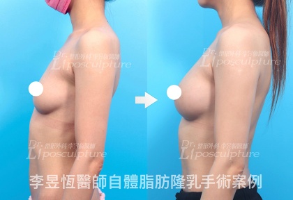 自體脂肪隆乳-28