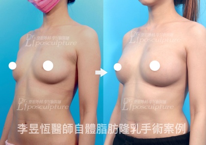 自體脂肪隆乳-29