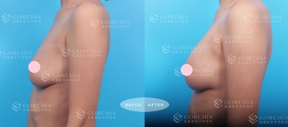 自體脂肪隆乳-33