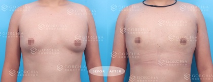 男性女乳手術-7