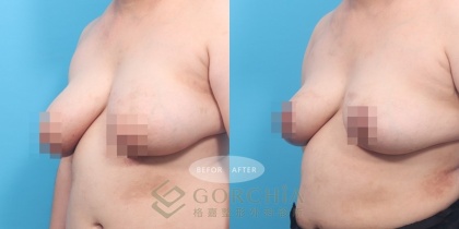 縮乳手術-2