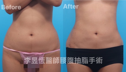 體態雕塑手術-1