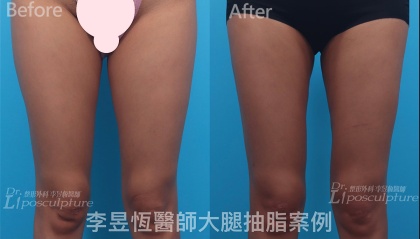 體態雕塑手術-2