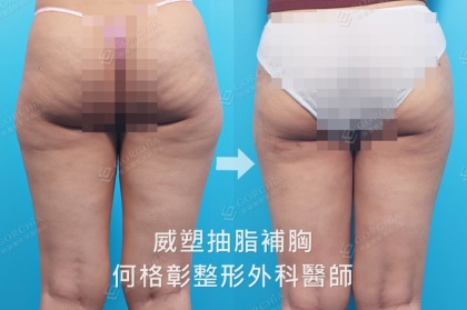 體態雕塑手術-3