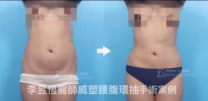 體態雕塑手術-8