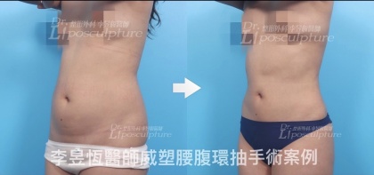 體態雕塑手術-9
