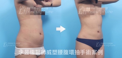 體態雕塑手術-10