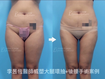 體態雕塑手術-11