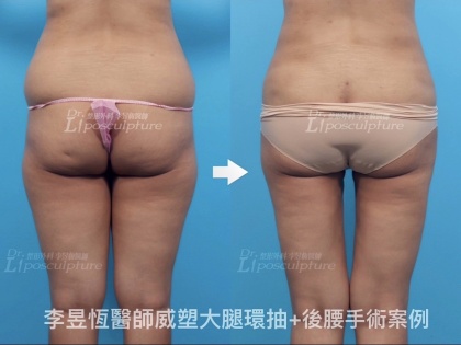 體態雕塑手術-12