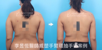 體態雕塑手術-13