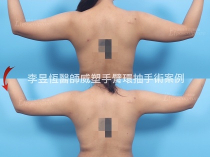 體態雕塑手術-14