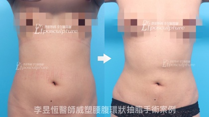 體態雕塑手術-18