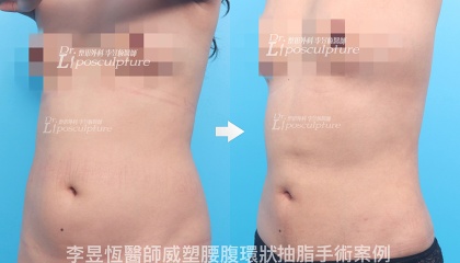 體態雕塑手術-20