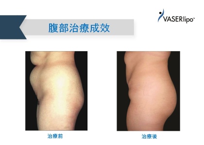 威塑抽脂手術-1