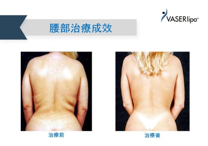 威塑抽脂手術-3