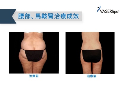 威塑抽脂手術-4