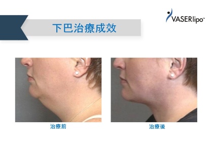 威塑抽脂手術-6