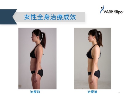 威塑抽脂手術-9