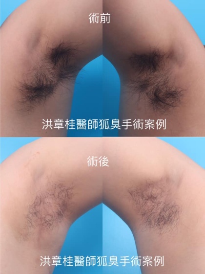 狐臭頂漿腺手術-1