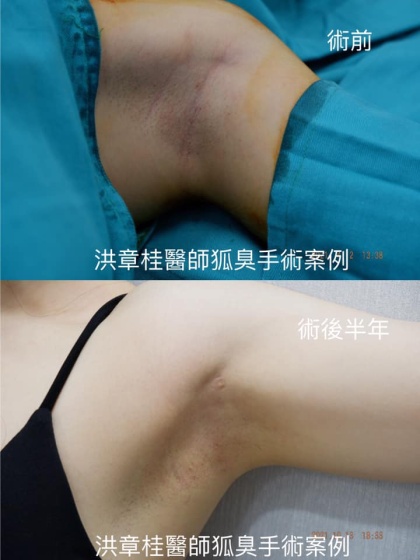 狐臭頂漿腺手術-2