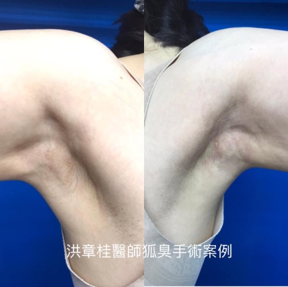 狐臭頂漿腺手術-3