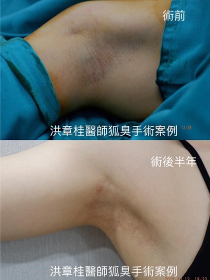 狐臭頂漿腺手術-4
