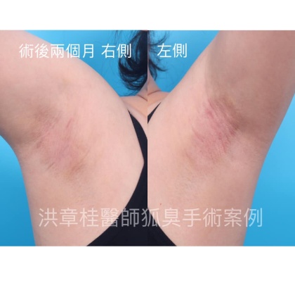 狐臭頂漿腺手術-5