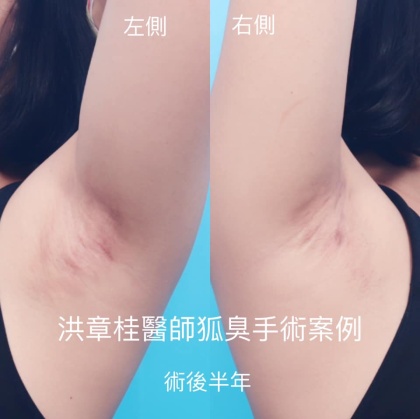 狐臭頂漿腺手術-6