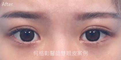 割雙眼皮手術-1