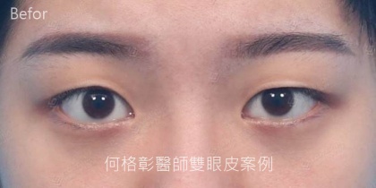 割雙眼皮手術-2