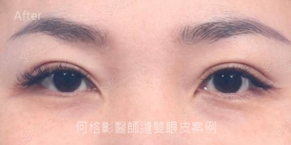 割雙眼皮手術-3