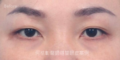 割雙眼皮手術-4
