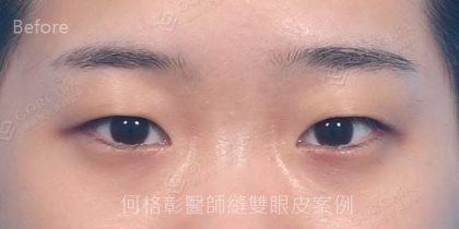 割雙眼皮手術-5