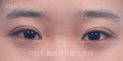 割雙眼皮手術-6