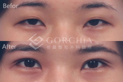 割雙眼皮手術-7