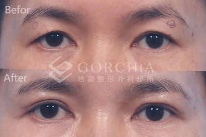 割雙眼皮手術-8