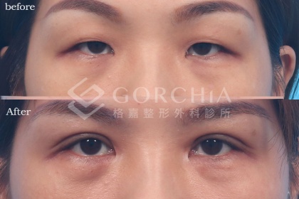 割雙眼皮手術-18