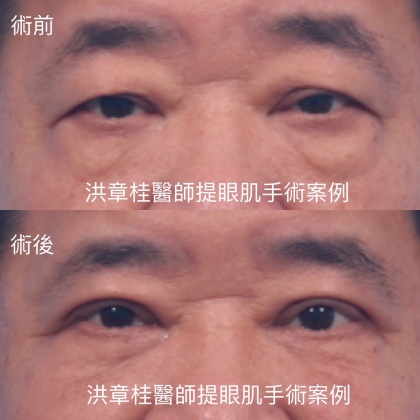 提眼肌手術-1