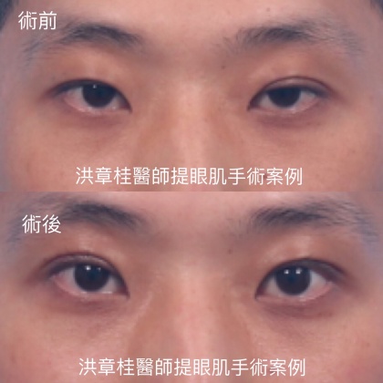 提眼肌手術-2