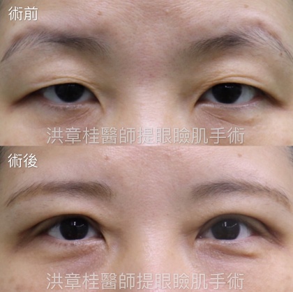提眼肌手術-3