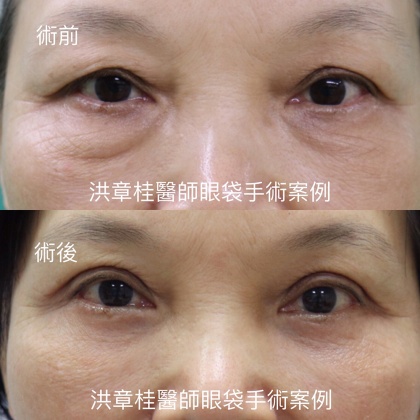 眼袋手術-1