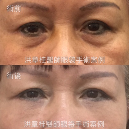 眼袋手術-3