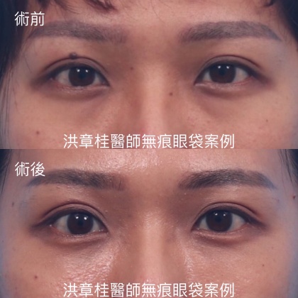 眼袋手術-4