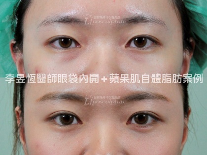 眼袋手術-6