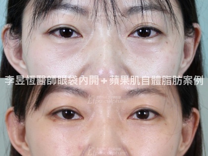 眼袋手術-7