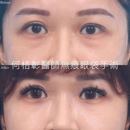 眼袋手術-11