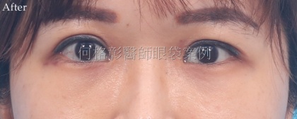 眼袋手術-12