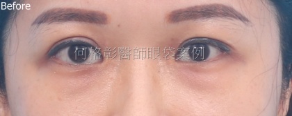 眼袋手術-13