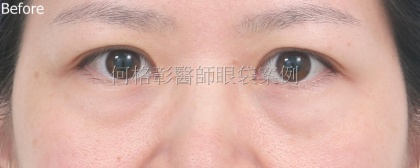 眼袋手術-14